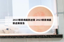 2023银屑病最新进展 2023银屑病最新进展报告