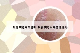 银屑病能用白醋吗 银屑病可以用醋洗澡吗