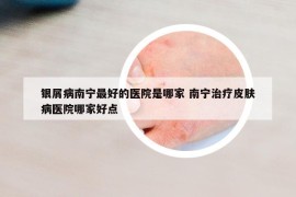 银屑病南宁最好的医院是哪家 南宁治疗皮肤病医院哪家好点