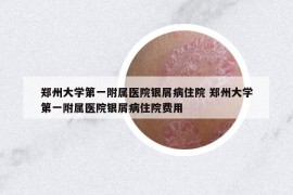 郑州大学第一附属医院银屑病住院 郑州大学第一附属医院银屑病住院费用