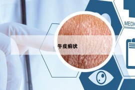牛皮癣状