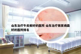 山东治疗牛皮癣好的医院 山东治疗银屑病最好的医院排名