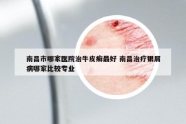 南昌市哪家医院治牛皮癣最好 南昌治疗银屑病哪家比较专业