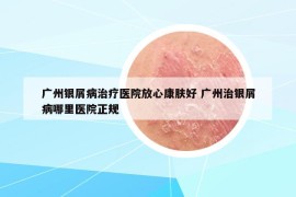 广州银屑病治疗医院放心康肤好 广州治银屑病哪里医院正规