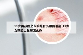 11岁男孩脸上长癣是什么原因引起 11岁女孩脸上起癣怎么办