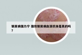 银屑病强力宁 强效银屑病血清抗体是真的吗?