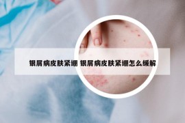 银屑病皮肤紧绷 银屑病皮肤紧绷怎么缓解