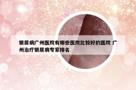 银屑病广州医院有哪些医院比较好的医院 广州治疗银屑病专家排名