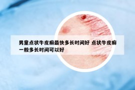 男童点状牛皮癣最快多长时间好 点状牛皮癣一般多长时间可以好