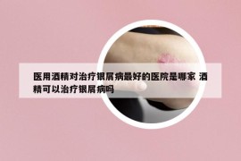 医用酒精对治疗银屑病最好的医院是哪家 酒精可以治疗银屑病吗