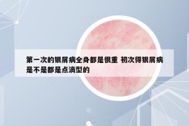 第一次的银屑病全身都是很重 初次得银屑病是不是都是点滴型的