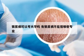 银屑病可以考大学吗 有银屑病不能报哪些专业