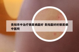 贵阳市中治疗银屑病最好 贵阳最好的银屑病中医院