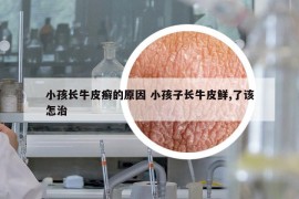 小孩长牛皮癣的原因 小孩子长牛皮鲜,了该怎治