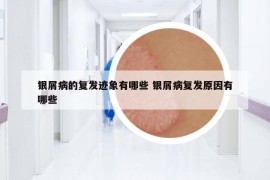 银屑病的复发迹象有哪些 银屑病复发原因有哪些