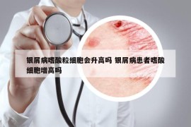 银屑病嗜酸粒细胞会升高吗 银屑病患者嗜酸细胞增高吗
