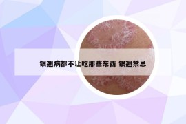 银翘病都不让吃那些东西 银翘禁忌
