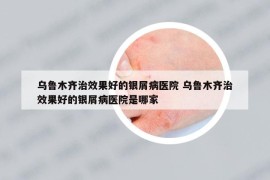 乌鲁木齐治效果好的银屑病医院 乌鲁木齐治效果好的银屑病医院是哪家
