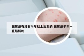 银屑病有没有半年以上治愈的 银屑病半年一直起新的