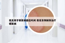 类克用于银屑病最佳时间 类克生物制剂治疗银屑病