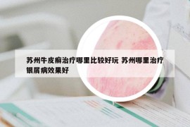 苏州牛皮癣治疗哪里比较好玩 苏州哪里治疗银屑病效果好