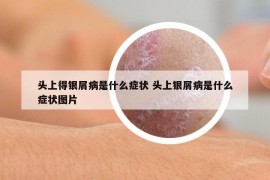 头上得银屑病是什么症状 头上银屑病是什么症状图片
