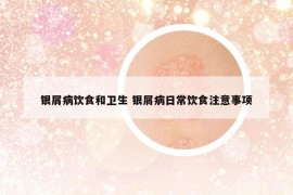 银屑病饮食和卫生 银屑病日常饮食注意事项