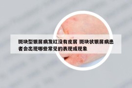 斑块型银屑病发红没有皮屑 斑块状银屑病患者会出现哪些常见的表现或现象