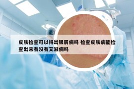 皮肤检查可以得出银屑病吗 检查皮肤病能检查出来有没有艾滋病吗