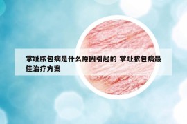 掌趾脓包病是什么原因引起的 掌趾脓包病最佳治疗方案