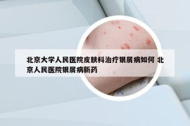 北京大学人民医院皮肤科治疗银屑病如何 北京人民医院银屑病新药