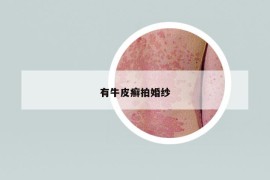 有牛皮癣拍婚纱