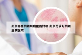 南京哪里的银屑病医院好啊 南京比较好的银屑病医院