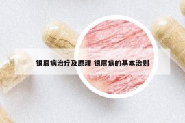 银屑病治疗及原理 银屑病的基本治则