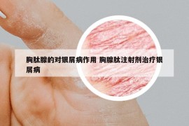 胸肽腺的对银屑病作用 胸腺肽注射剂治疗银屑病