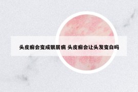 头皮癣会变成银屑病 头皮癣会让头发变白吗