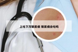 上吐下泻银屑病 银屑病会吐吗