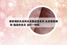 银屑病的头皮和头皮脂溢性皮炎 头皮银屑病 和 脂溢性皮炎 治疗一样吗