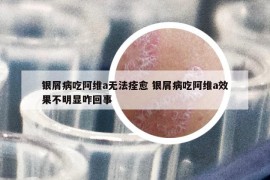 银屑病吃阿维a无法痊愈 银屑病吃阿维a效果不明显咋回事