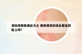 发际线银屑病达力士 银屑病发际线会蔓延到脸上吗?
