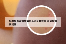 标准型点滴银屑病怎么治可自愈吗 点滴型银屑结果