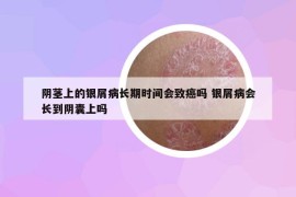 阴茎上的银屑病长期时间会致癌吗 银屑病会长到阴囊上吗