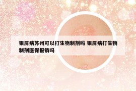 银屑病苏州可以打生物制剂吗 银屑病打生物制剂医保报销吗