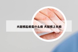 大腿根起癣是什么癣 大腿根上长癣