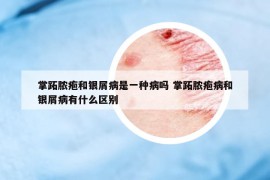 掌跖脓疱和银屑病是一种病吗 掌跖脓疱病和银屑病有什么区别