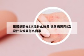 银屑病照光8次没什么效果 银屑病照光8次没什么效果怎么回事