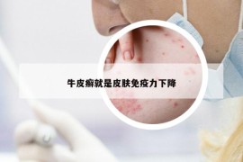 牛皮癣就是皮肤免疫力下降