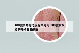 100度的水能把皮藓杀死吗 100度的水能杀死红色毛癣菌