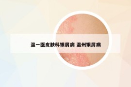 温一医皮肤科银屑病 温州银屑病