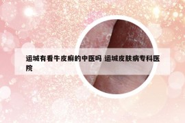 运城有看牛皮癣的中医吗 运城皮肤病专科医院